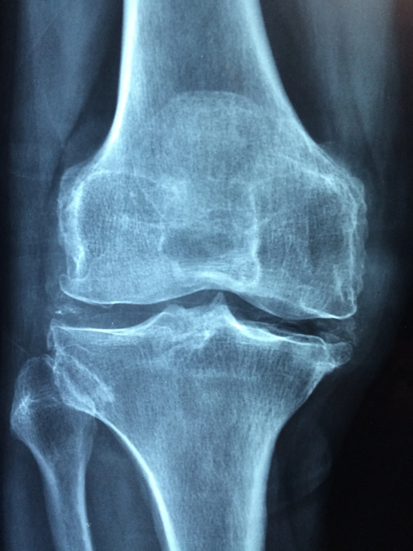 Rheumatic heart disease